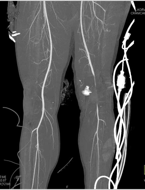 Gsw With Occlusion Of The Left Superficial Femoral Artery Sfa And