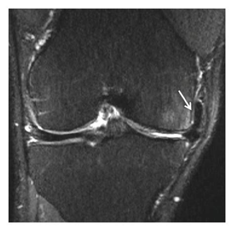 Meniscal Fragments From Horizontal Meniscal Tears Displaced Under The Download Scientific