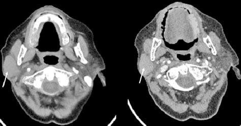 A Native Ct Reveals A Spontaneously Hyperdense Solid Mass Occupying