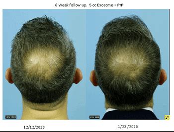 Exosome hair loss therapy exosomes are one of the most exiting therapy tools in regenerative medicine today. Hair Loss Cure 2020 | Page 2 of 247 | Hair loss cure news ...