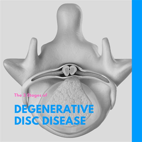 The 3 Stages Of Degenerative Disc Disease New Jersey Comprehensive