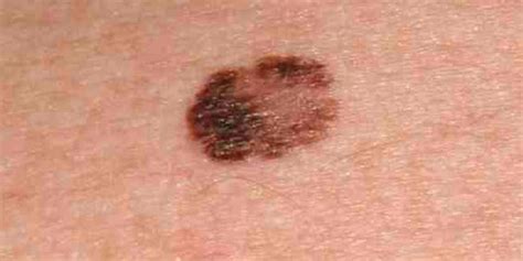 Melanoma Skin Cancer Spots On Face