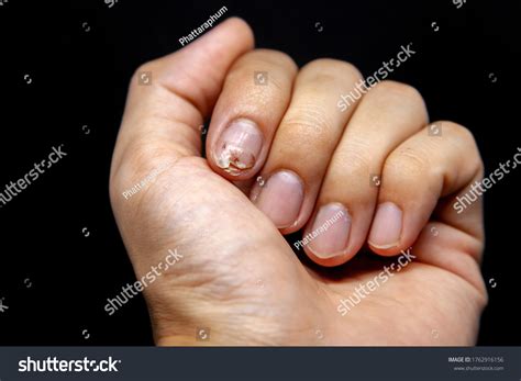 Hand That Causes Hematoma Stock Photo 1762916156 Shutterstock
