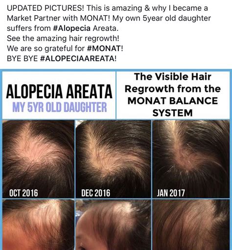Do You Suffer From Alopecia Here Are Real Results With Monat No