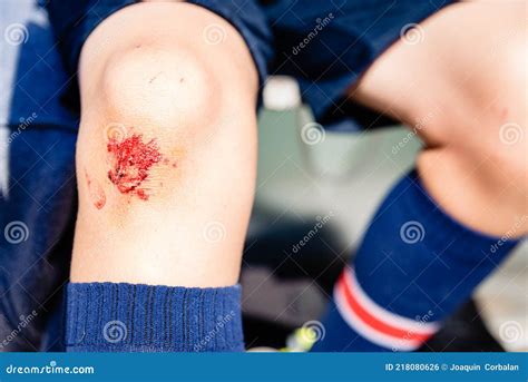 Blood Wound On The Knee Of A Child Athlete Stock Photo Image Of