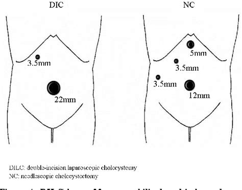 Laparoscopic Cholecystectomy Incisions
