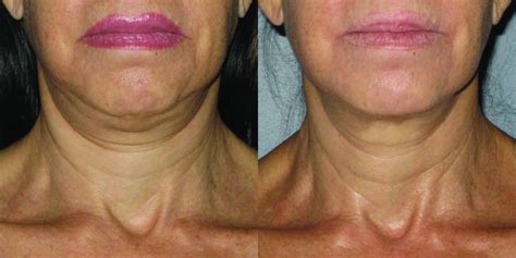 Ultherapy® Before & After Photos Patient 109 | New Jersey ...