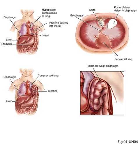Stage 4 colon cancer is the most advanced stage of the disease and may also be referred to as metastatic colon cancer. Diaphragmatic Hernia (Congenital), Pediatric | Diseases ...