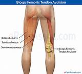 Back Of Knee Tendon Pain Treatment Images