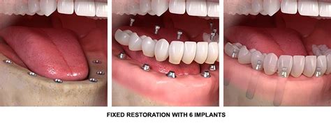 How Good Are Mini Dental Implants Dental News Network