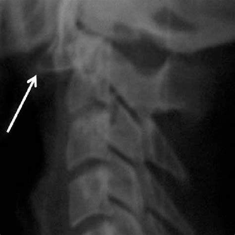 —the Cervical Spine Mri Revealed A Normal Calibre Of The Vertebral