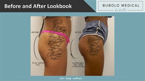 NON SURGICAL BRAZILIAN BUTT LIFT Bubolo Medical