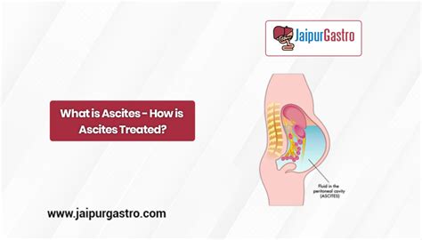 What Is Ascites How Is Ascites Treated 2022