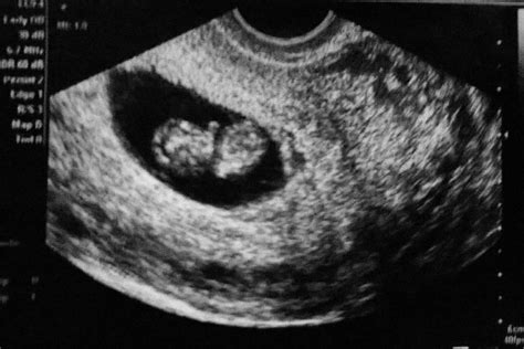 9 Week 4 Day Ultrasound Babycenter