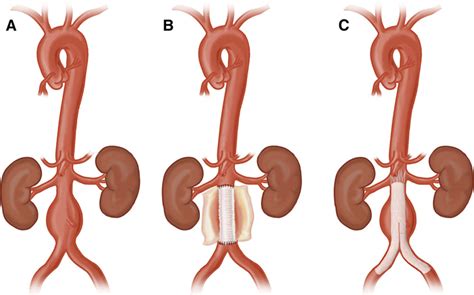 Open And Endovascular Management Of Aortic Aneurysms Circulation Research
