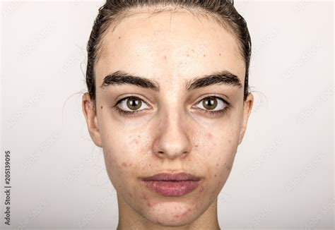 Beautiful Young Girl With Problematic Skin Acne Problem Concept Stock