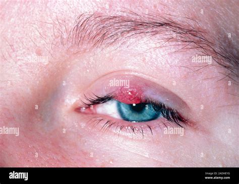 A Chalazion Or Meibomian Cyst On The Eyelid A Swollen And Inflamed