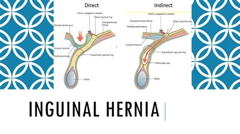 Inguinal Hernia Types Causes Symptoms Treatment Preve