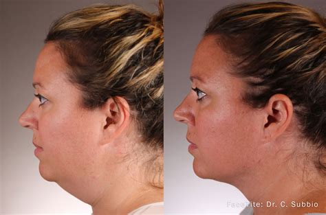 Facial Contouring Before And After Southeastern Dermatology