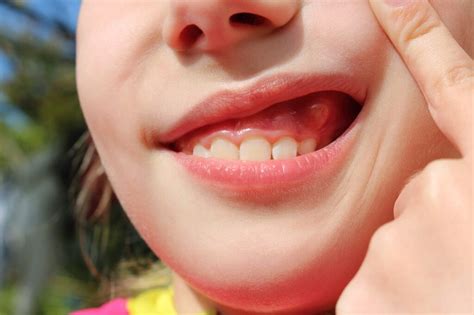 Hard Bony Lump On Gum 8 Common Reasons For Mouth Growths