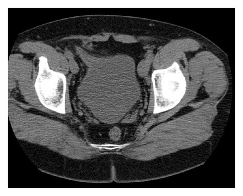 Noncontrast Ct Right Inguinal Hernia Containing The Bladder Wall