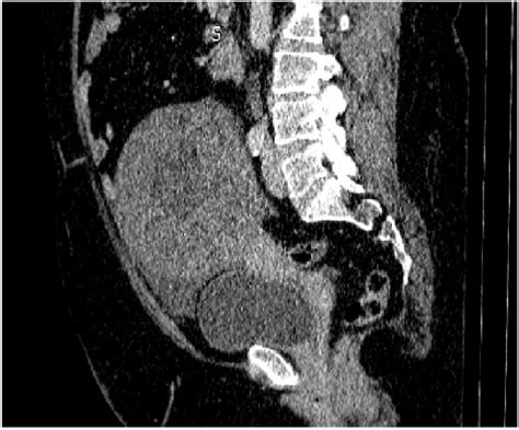 Computed Tomography Scan Of The Pelvic Mass Download Scientific Diagram