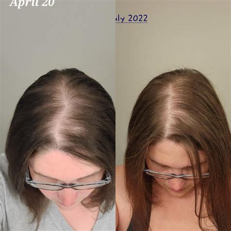 Spironolactone For Hair Loss Rfemalehairloss