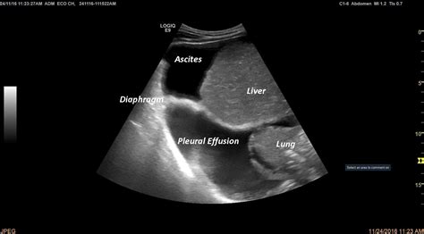 Ascites And Pleural Effusion In A Cirrhotic Patient 1 Image Efsumb