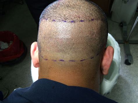 Close Up Example Of Donor Strip Scar And Smp Hair Loss Forum Hair