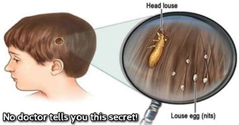 No Doctor Tells You This Secret How To Get Rid Of Head Lice Fast And