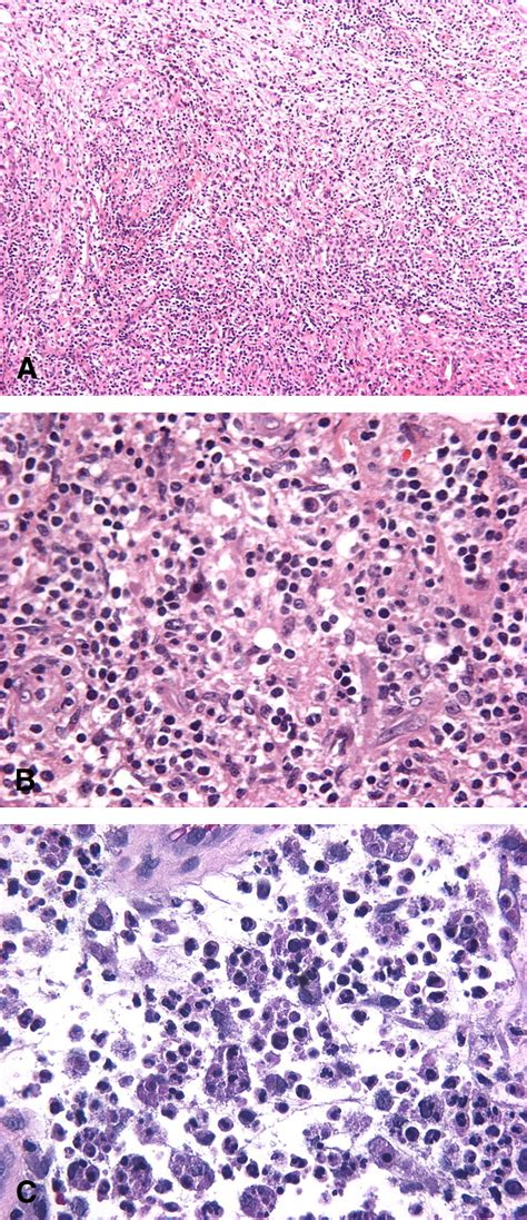 Aggressive Histiocytic Disorders That Can Involve The Skin Journal Of