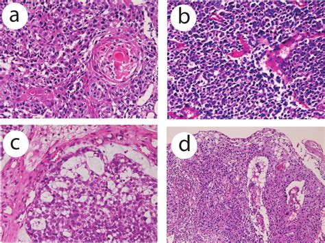 A Histology Of Squamous Cell Carcinoma Element Of The Esophageal Download Scientific Diagram