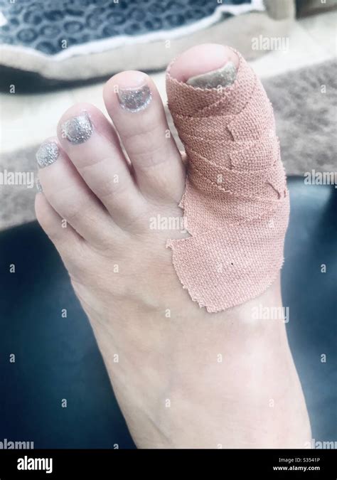 Fractured Left Big Toe Being Treated In A Toe Spica Stock Photo Alamy