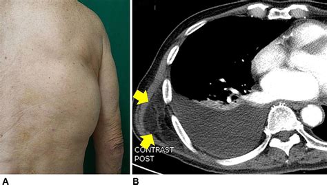 A Liposarcoma Of The Chest Wall And Back Journal Of The American