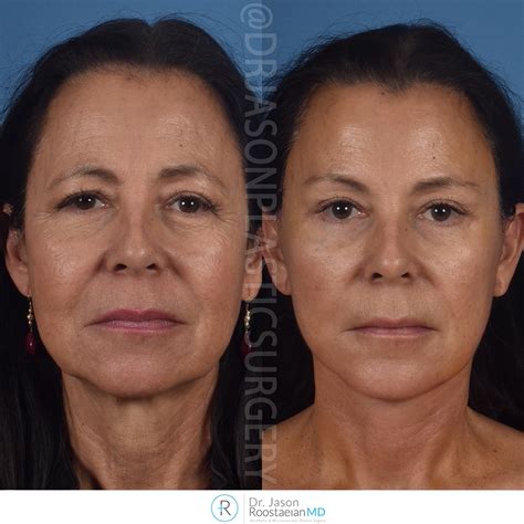 Dr Jasons One Week Brow Neck And Facelift Results Natural Looking