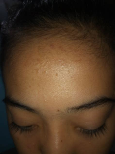 Pimples All Over My Forehead General Acne Discussion Community