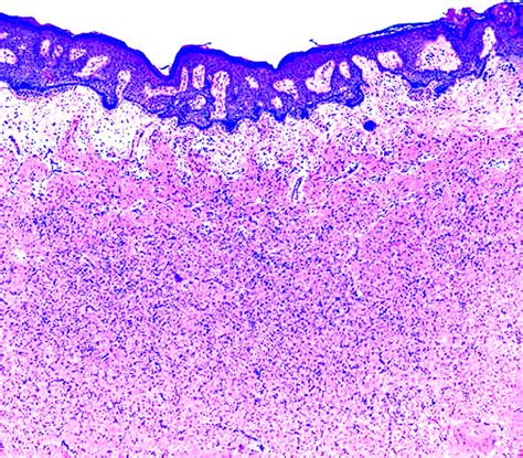 Pathology Outlines Dermatofibroma Benign Fibrous Histiocytoma