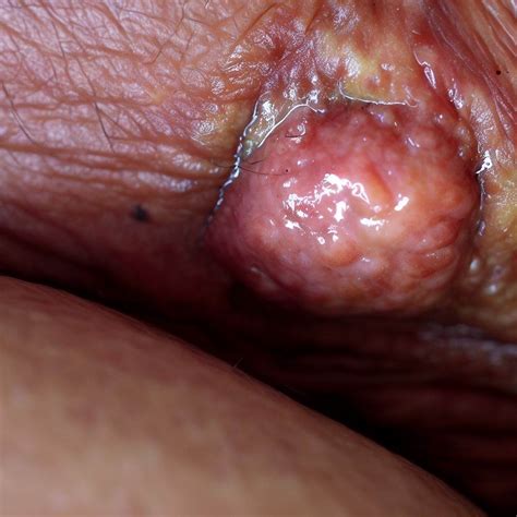 Picior Umflat Ulcer Varicos Cauze Simptome I Tratament Ghelari