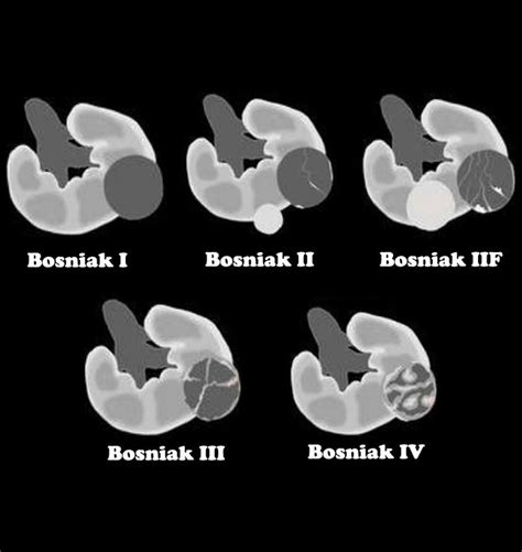 Bosniak Classification For Renal Cysts Diagnostic Medical Sonography