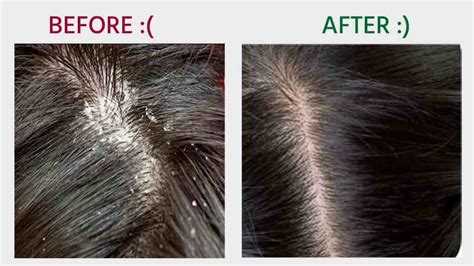 How To Remove Dandruff Dandruff Treatment Personal Experience And Best