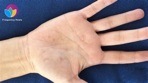 Dyshidrosis Relief Reduce Blisters On Hands And Feet And Alleviate Pain