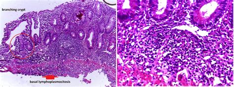 gastrointestinal and liver histology pathology atlas colon ulcerative colitis