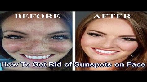 How To Get Rid Of Sunspots On Face Best Way To Get Rid Of Sunspots On