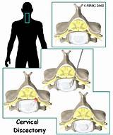 Cervical Discectomy Recovery Photos