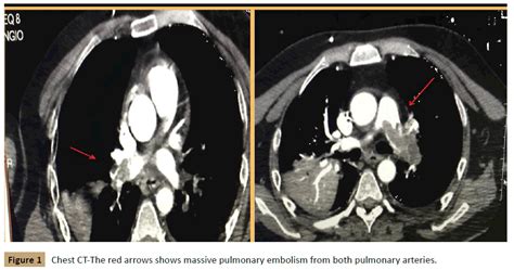 Toch is het lang niet altijd duidelijk en voelbaar of iemand. Pulmonary Embolism On Chest Ct : Chest Radiology : Chest ...