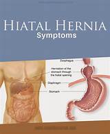 Images of Home Remedies Umbilical Hernia