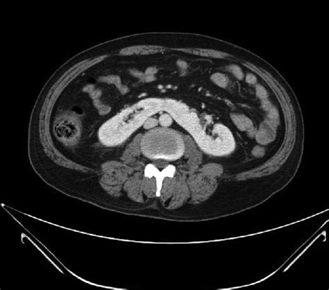 Deceased Donors Ct Scan Image Shows Isthmus Of Horseshoe Kidney