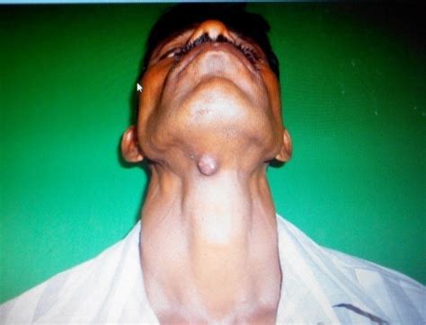 Swelling Below The Chin Download Scientific Diagram