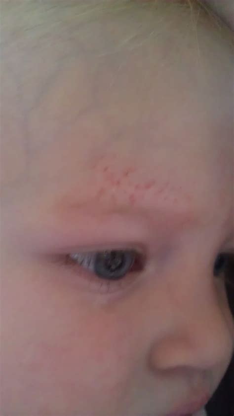 My 2 Yr Old Daughter Woke Up With A Rash Above Her Eyebrow