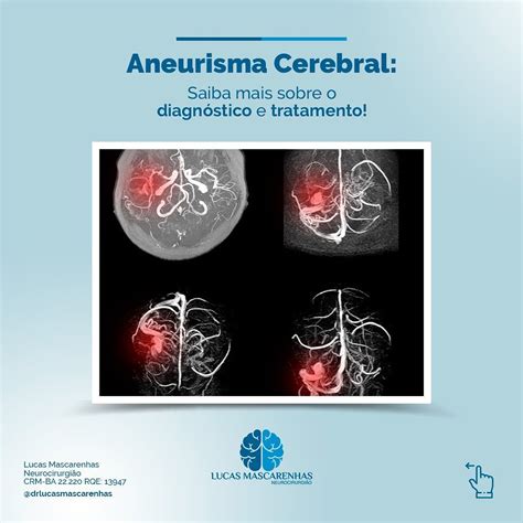 Aneurisma cerebral o que é sintomas causas e tratamento